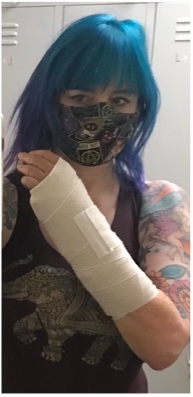 Tanya Jansen showing her wrist in a cast due to a temporary disability
